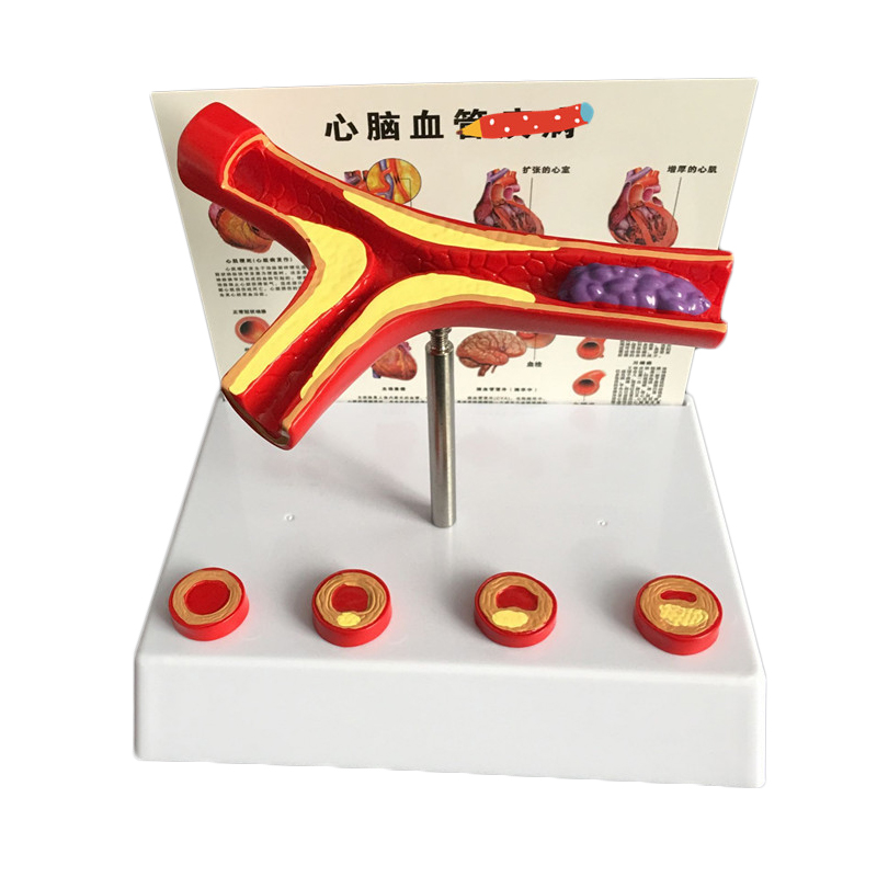 Medical Lab Supplies - 50-кратное увеличенное человеческое сосуд, атеросклероз, сосудистая
